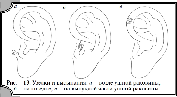 Шелушатся кожа вокруг ушей на ушах Шелушатся кожа вокруг ушей на ушах